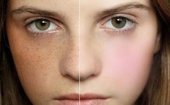 Kem trị nám tàn nhang Hàn Quốc Ezie Melasma Cream Freckles Age Spot