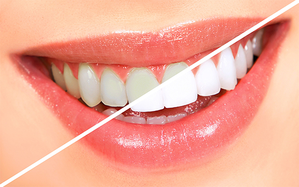 Các cách làm trắng răng hiệu quả tại nhà