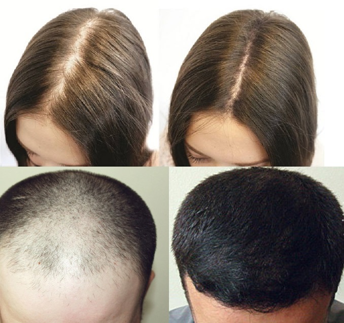 Đặc trị hói đầu chống rụng tóc